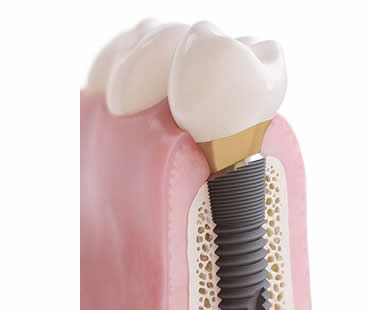 Choosing a Professional for Your Dental Implants in Meriden