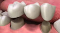 Understanding the Basics About Dental Crowns and Dental Bridges