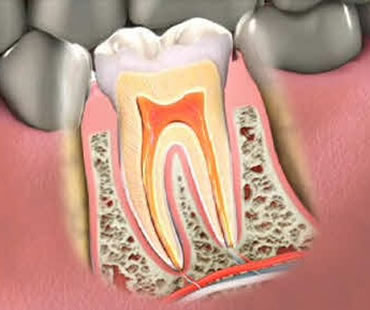 Private: Should an Endodontist Perform Your Root Canal Treatment?